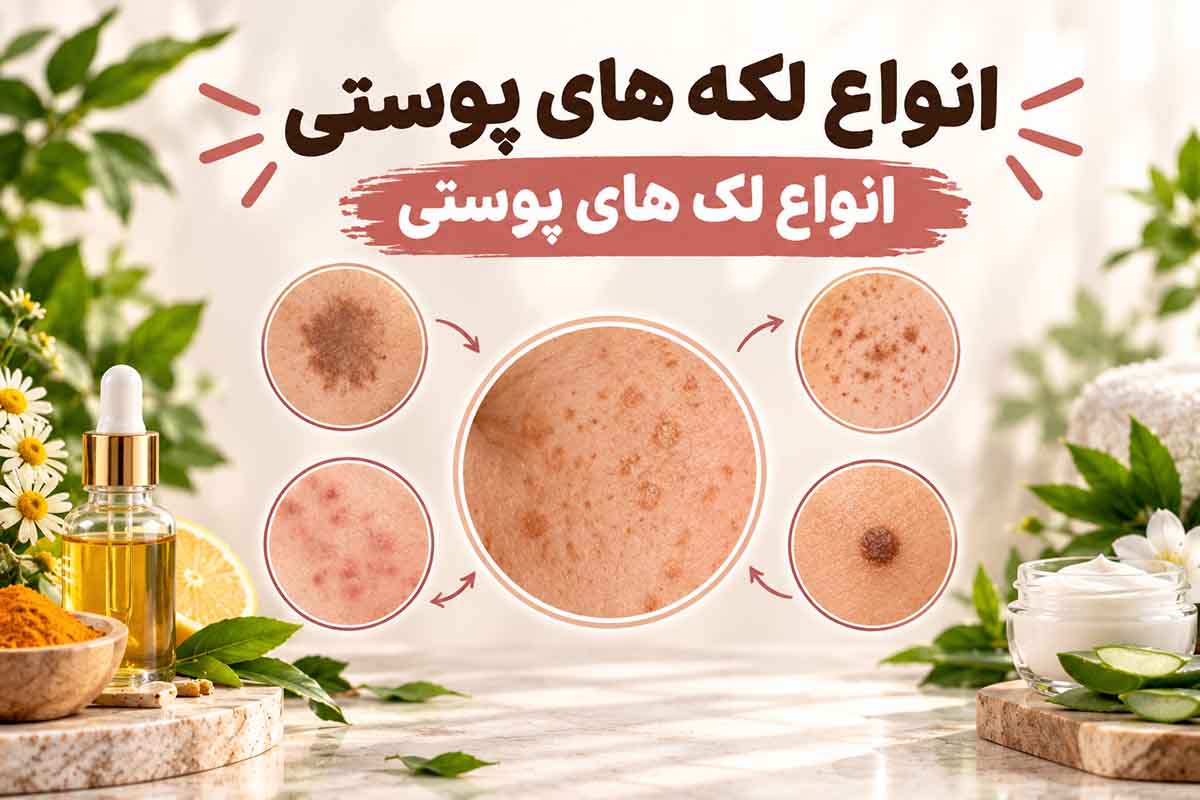 انواع لکه های پوستی